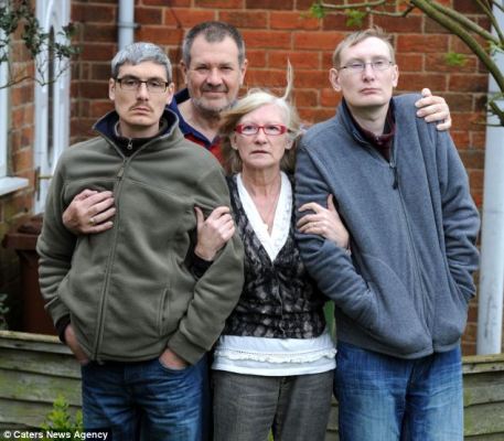 英國中年兄弟患罕見病癥 “返老還童”如電影