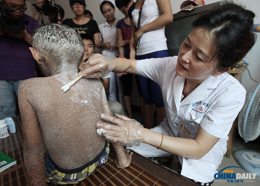 浙江溫嶺：“樹皮娃娃”渴望快樂童年