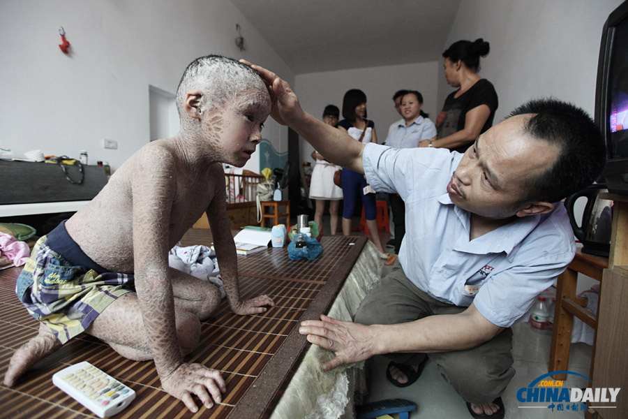 浙江溫嶺：“樹皮娃娃”渴望快樂童年