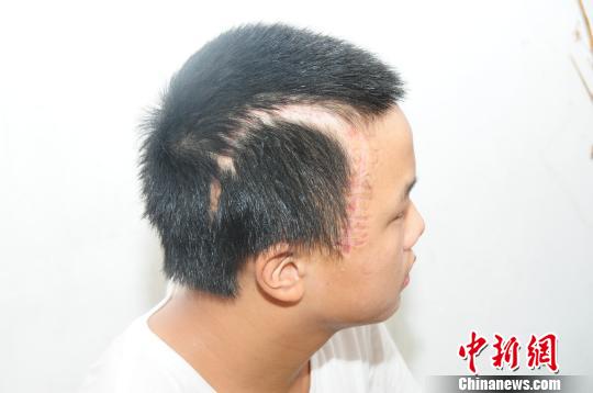 14歲男孩車禍重傷 因無力支付高額手術(shù)費父拒認子