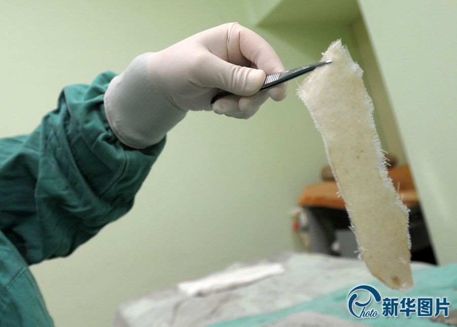 7歲女童全身70%面積燒傷 養母捐整塊頭皮救女