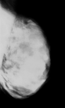 This is an undated handout image provided on Wednesday, Jan. 17, 2007 by the University of Texas M.D. Anderson Cancer Center in Houston showing a mammogram of a breast with dense tissue free of tumors. Dense breast tissue shows up lighter, obscuring cancer tumors, which also look light on mammograms. The mammogram of a breast with lots of fatty tissue (the opposite of dense) appears noticeably darker, so light tumors would show up better against that background. (AP